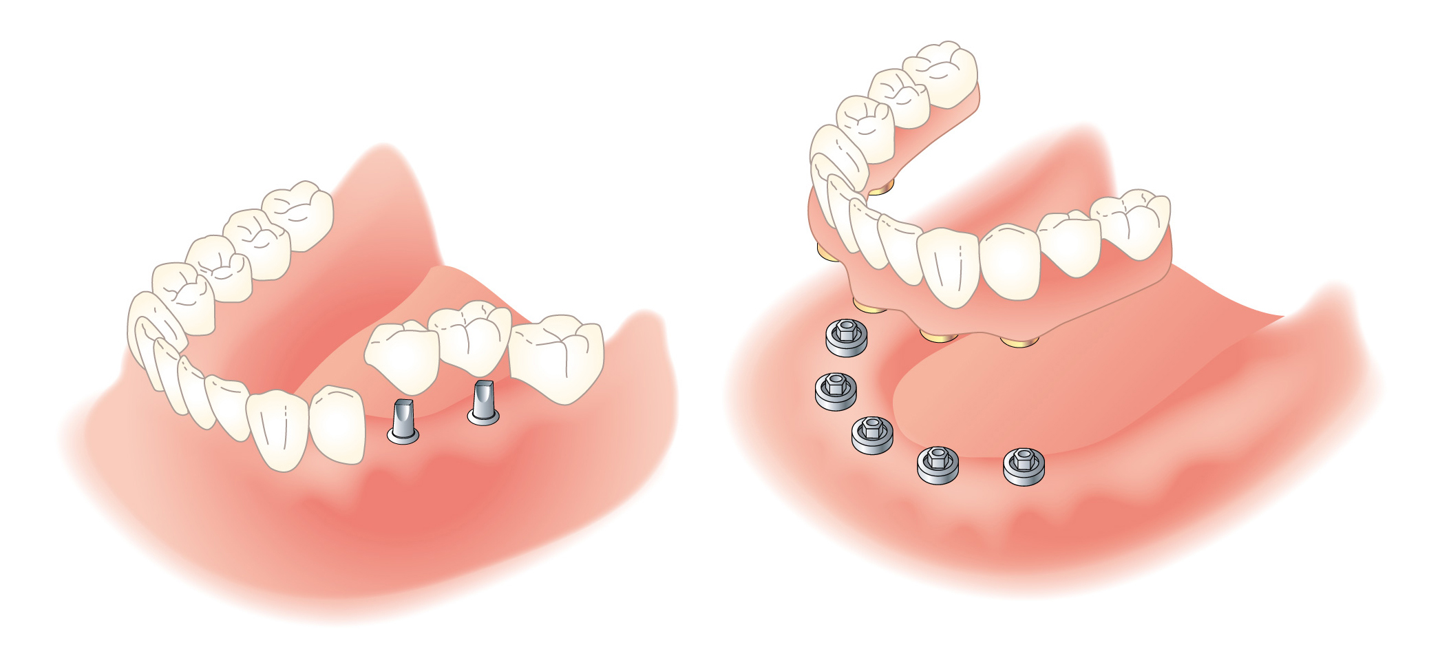 インプラントイメージ1